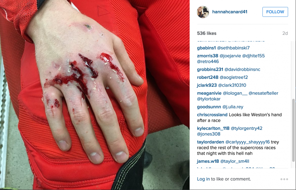 Canard's wife Hannah posted a photo of his injuries with the funny caption,