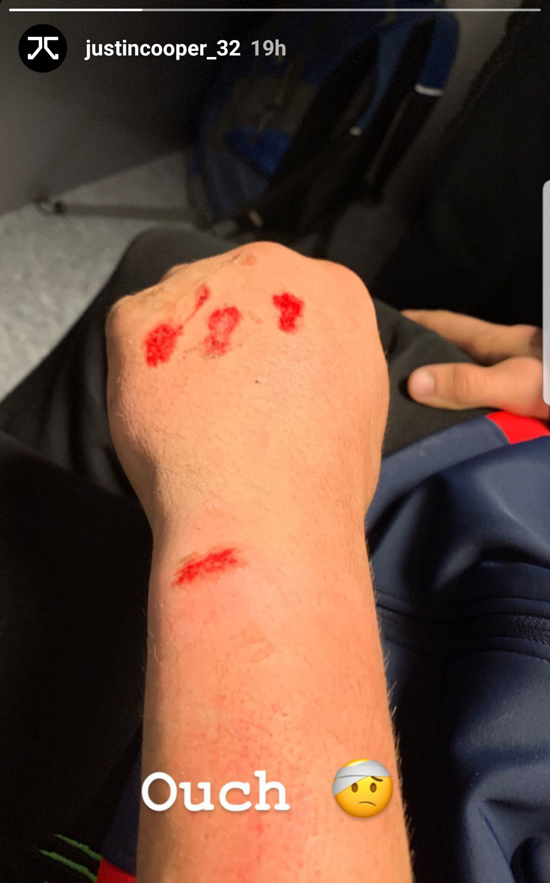 Cooper's hand following the incident in the first race Sunday at the Motocross of Nations.