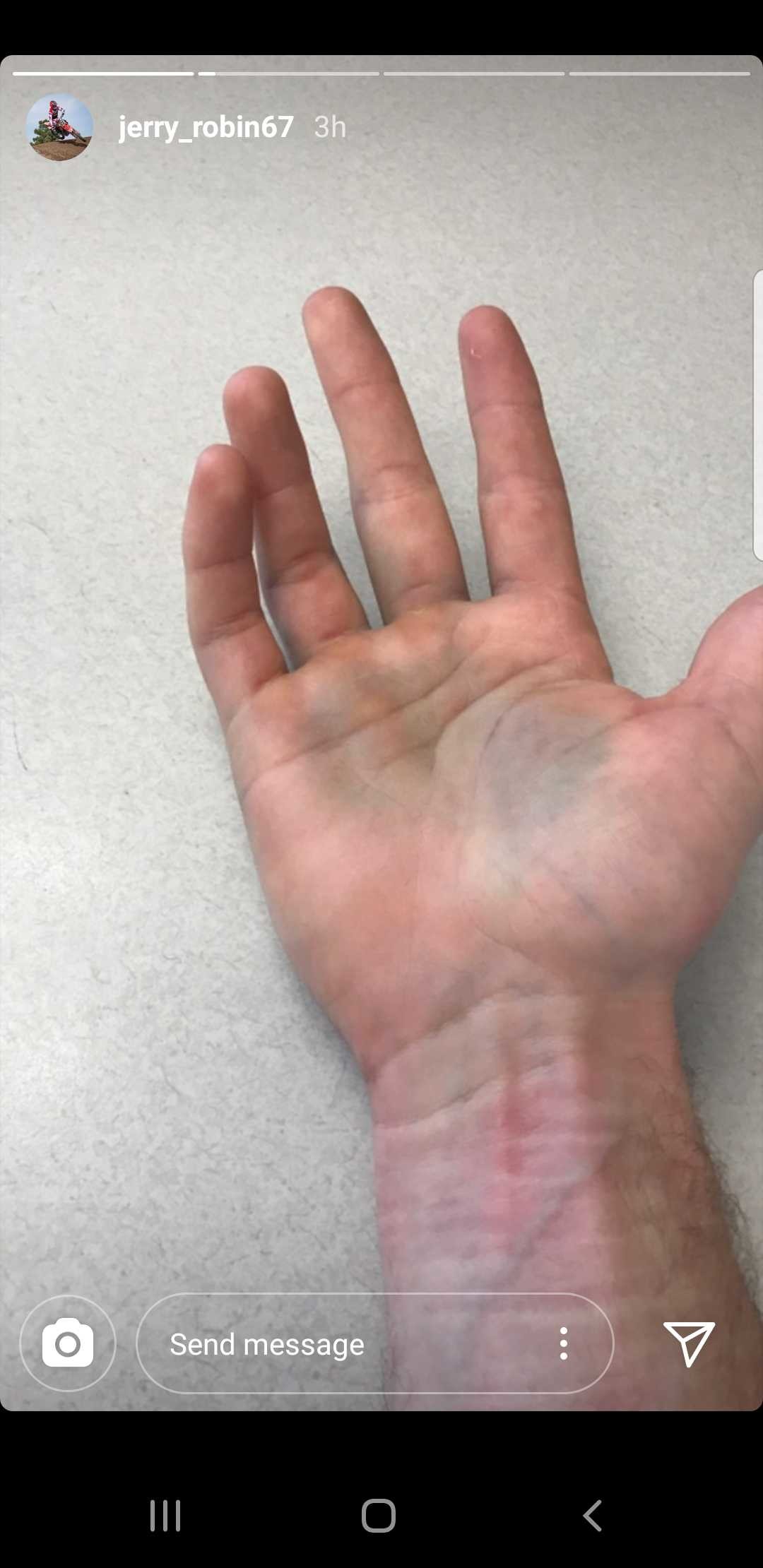 Robin's hand after the Daytona Supercross.