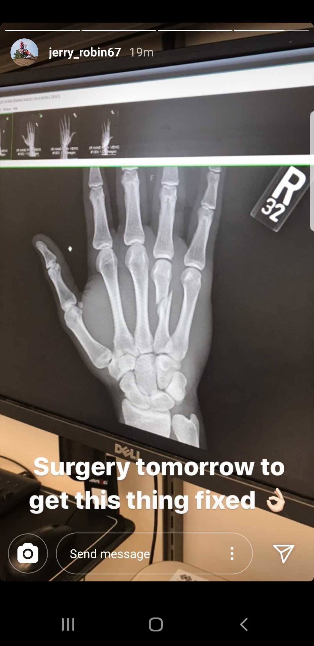 X-Rays of Robin's hand after the Daytona Supercross.