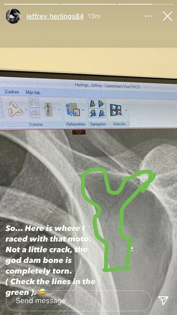 Jeffrey Herlings' X-ray.