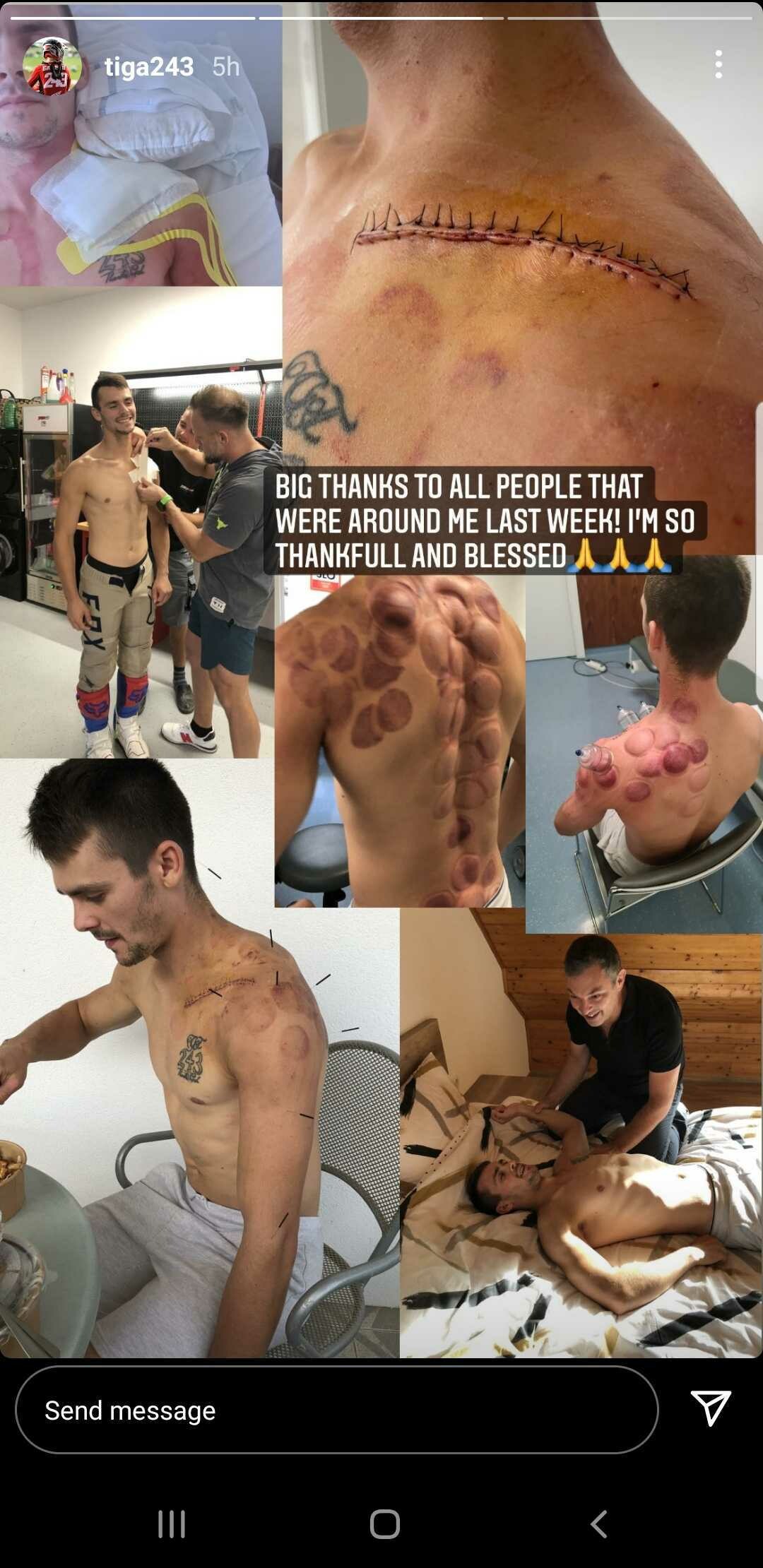 Gajser shared photos of his injury to Instagram.